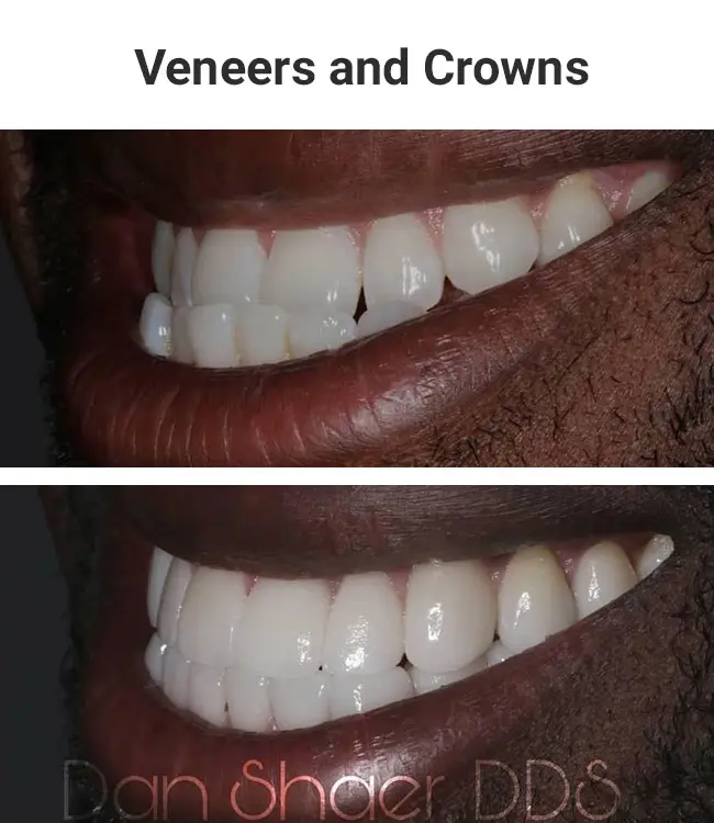 veneers-crowns