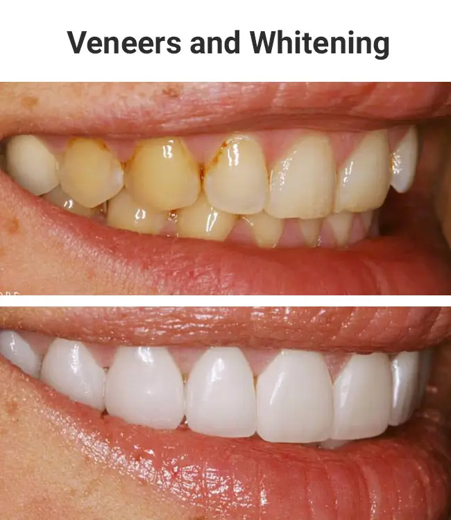 veneers-whitening01