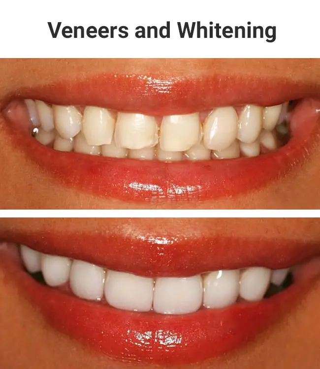 veneers-whitening02